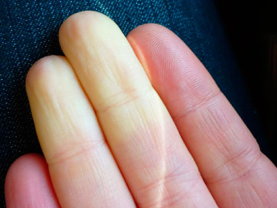 RAYNAUD’S SYNDROME